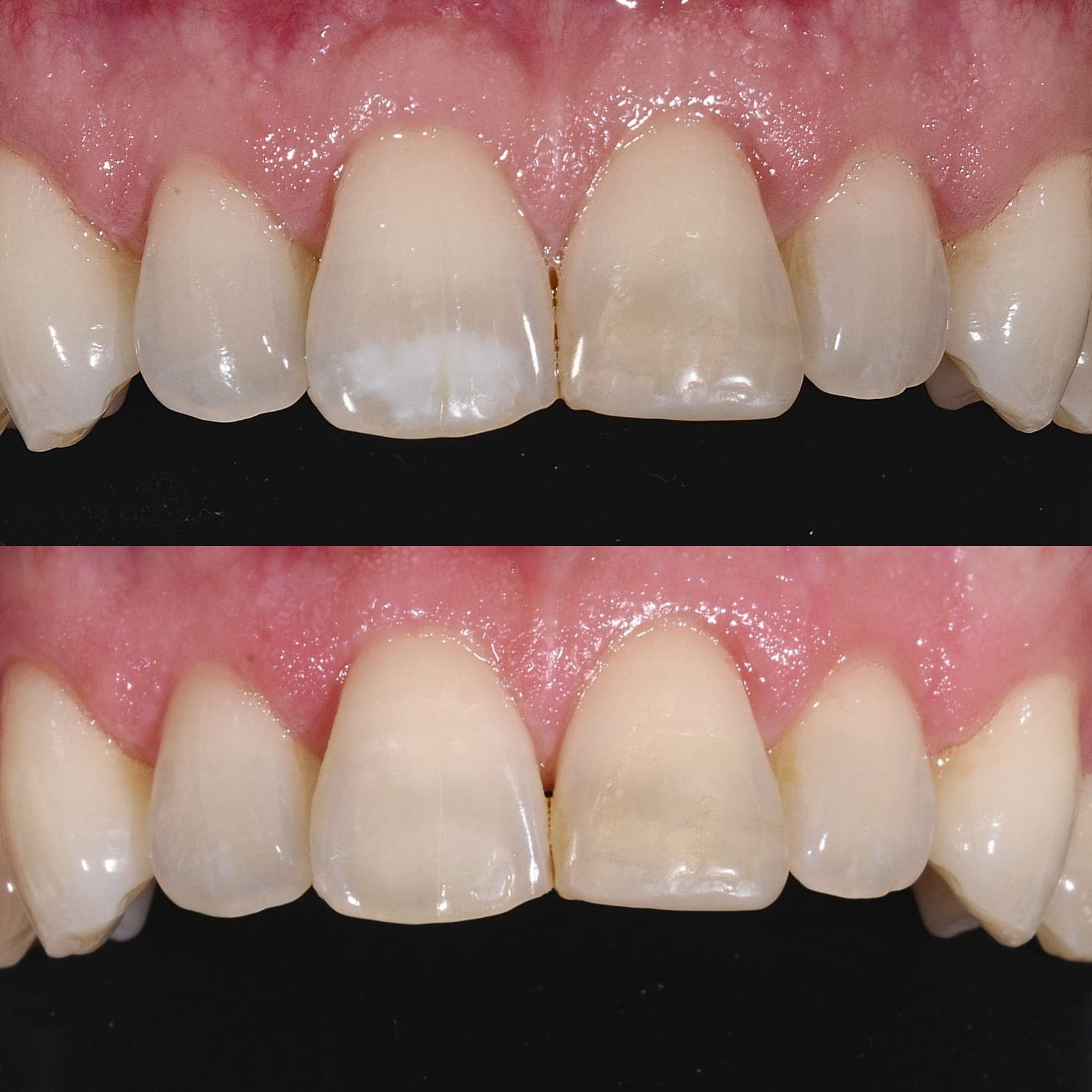 Trattamento discromie dello smalto - Caso 3