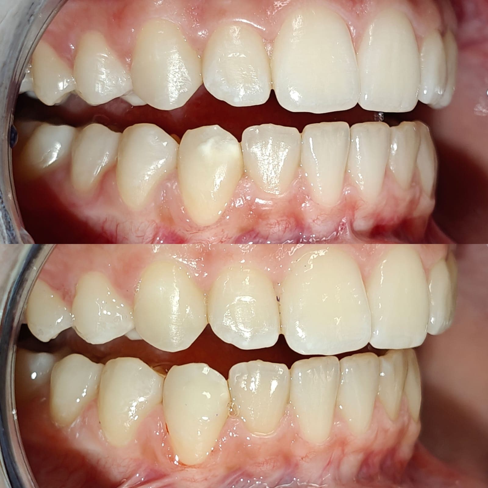 Trattamento discromie dello smalto - Caso 2