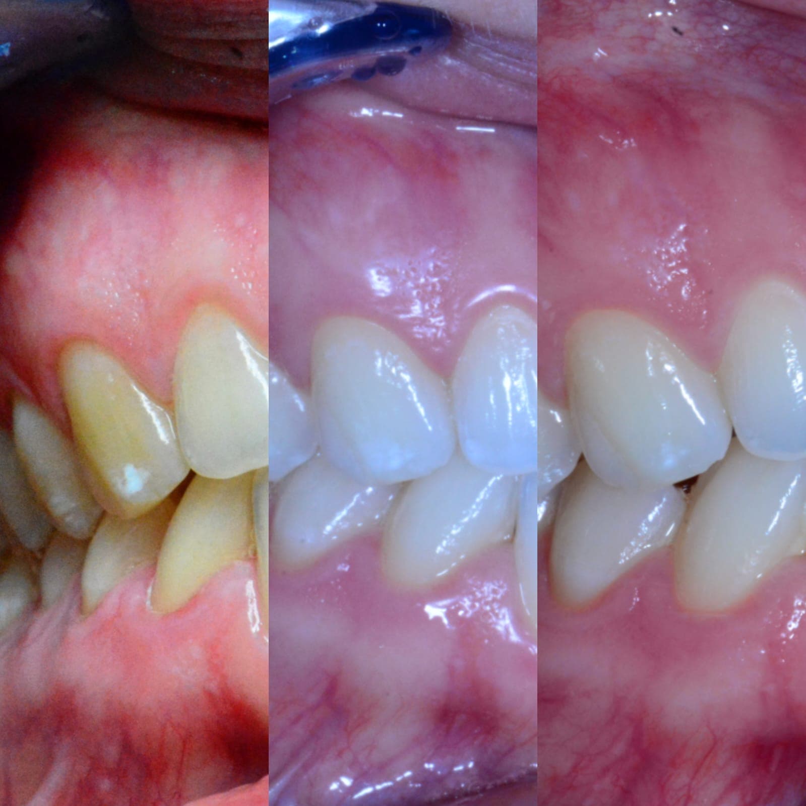Trattamento discromie dello smalto - Caso 1
