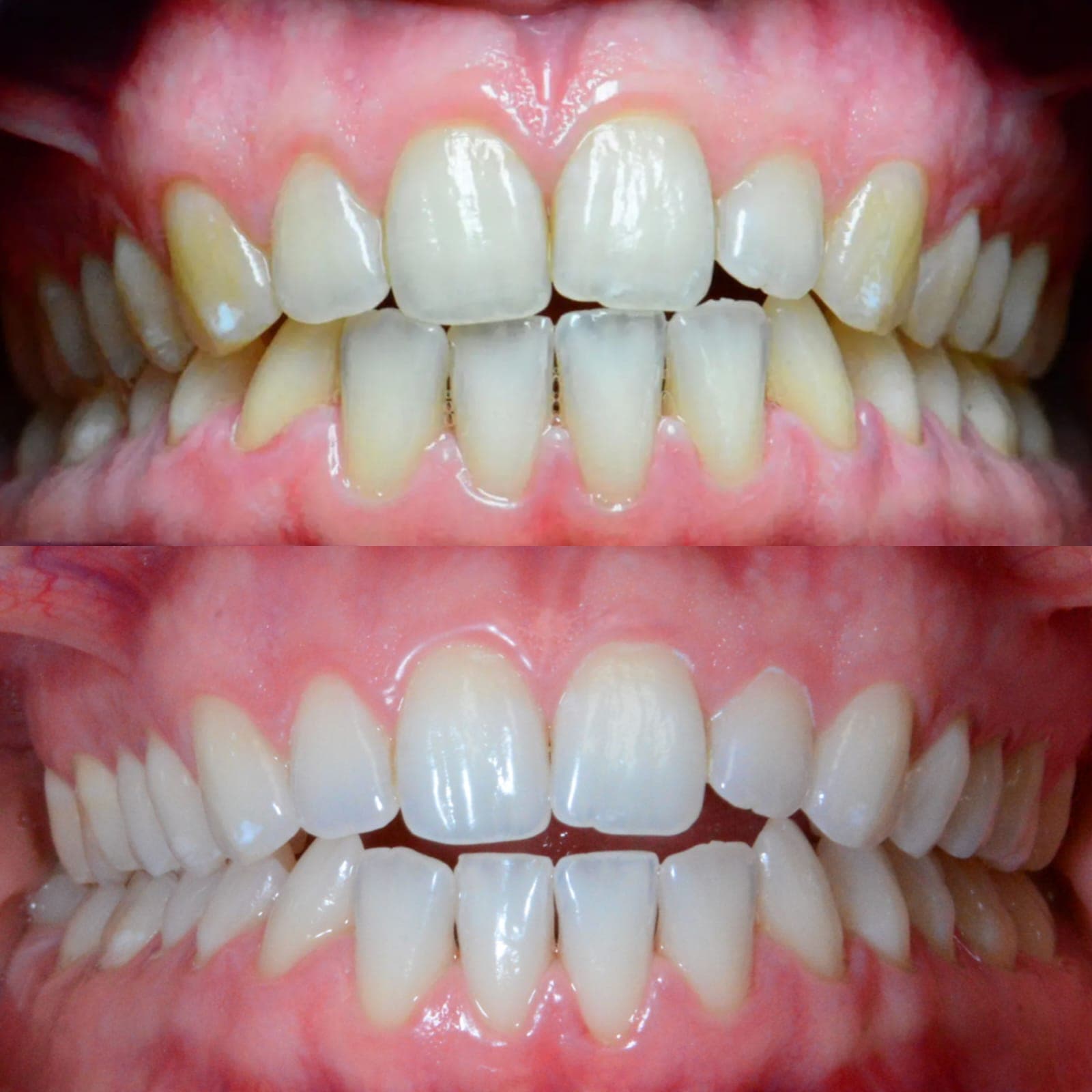 Sbiancamento domiciliare - Caso 1