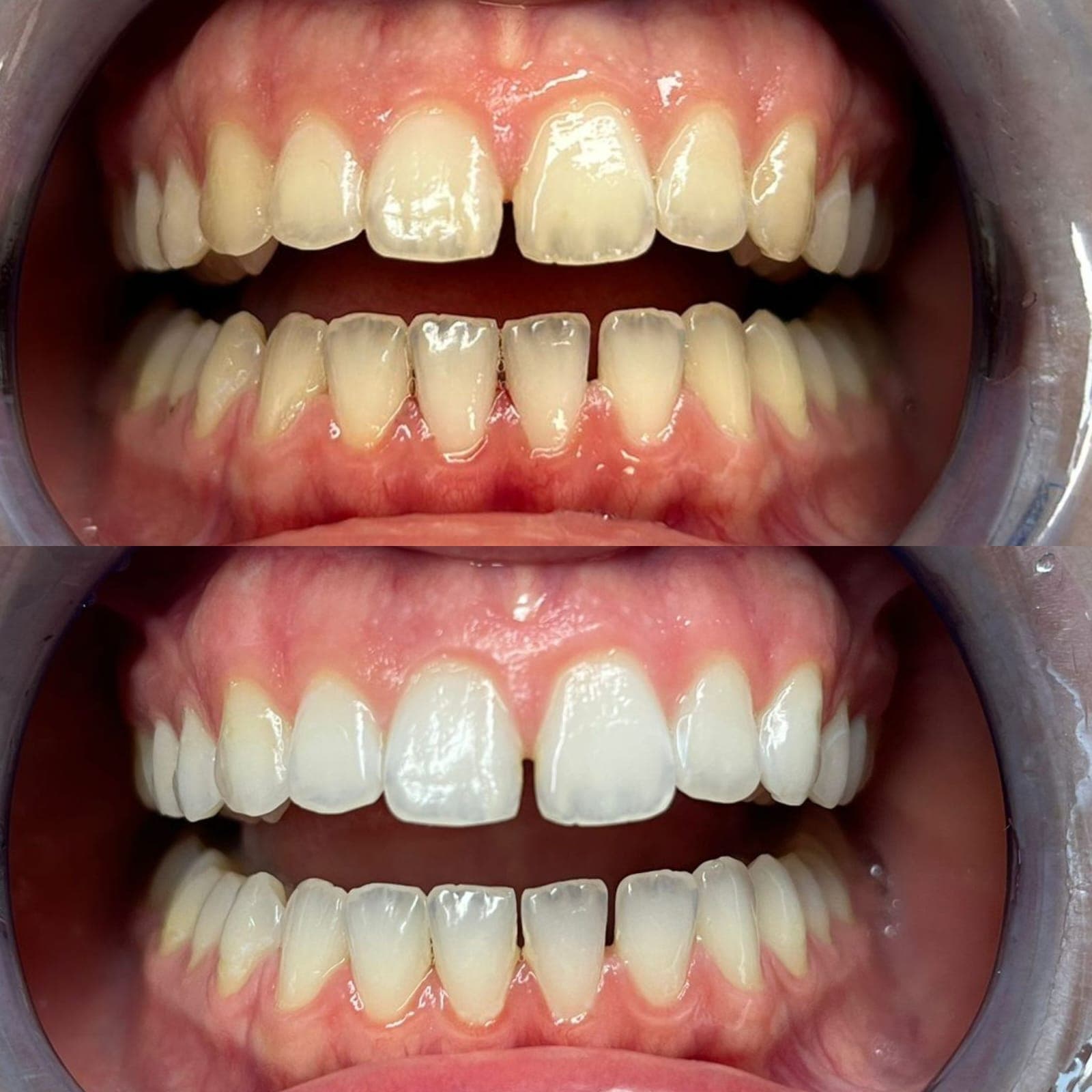 Sbiancamento domiciliare - Caso 2