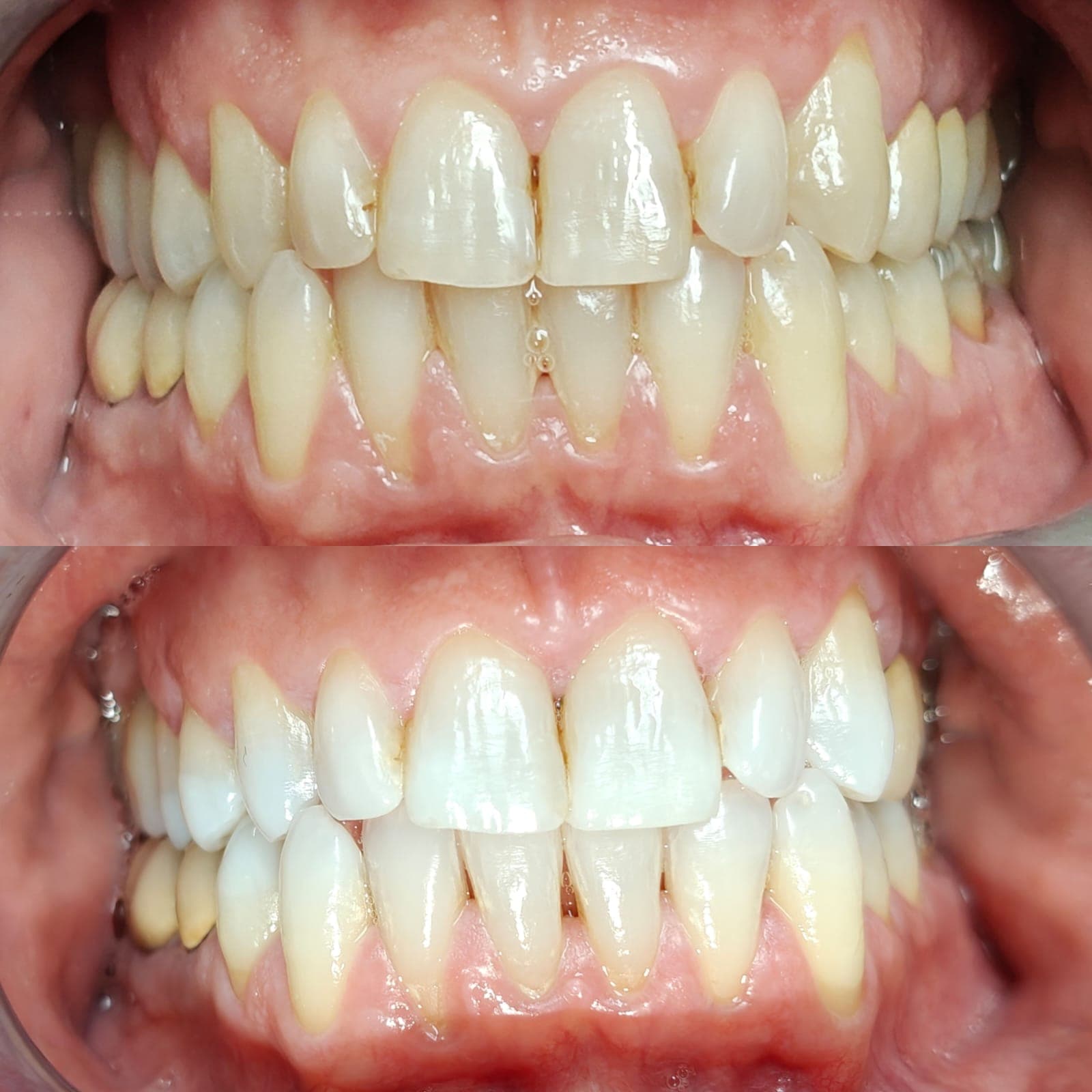 Sbiancamento domiciliare - Caso 3